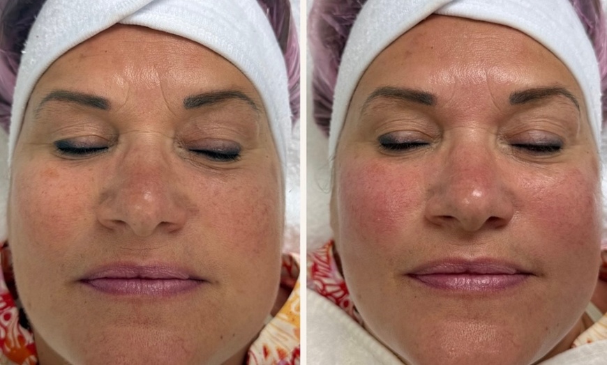 Image 5: Hydrafacial Glow & Lashlifting bij Beauty Clinic by Nouha