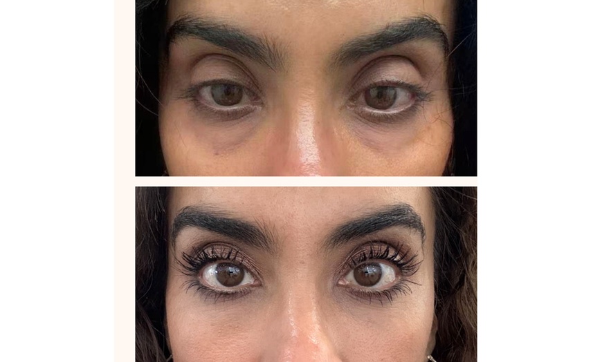 Image 2: PRP Plasma Injection for Hair/Scalp/Undereye or PRF for Undereyes