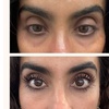 Image 2: PRP Plasma Injection for Hair/Scalp/Undereye or PRF for Undereyes