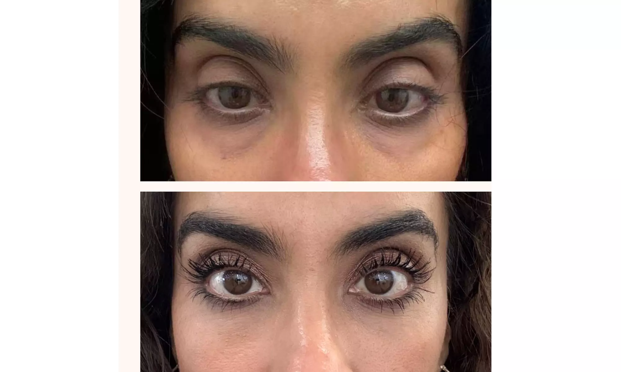 PRP Plasma Injection for Hair/Scalp/Undereye or PRF (Platelet-Rich Fibrin) for Undereyes at (Up to 66% Off) - Second Medium