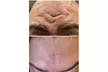 Smooth & Refreshed with 20, 40 or 60 Units of Xeomin at the GLO suite Up to  38% Off - Second Medium