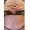 Image 3: Smooth & Refreshed with 20, 40 or 60 Units of Xeomin at the GLO suite 
