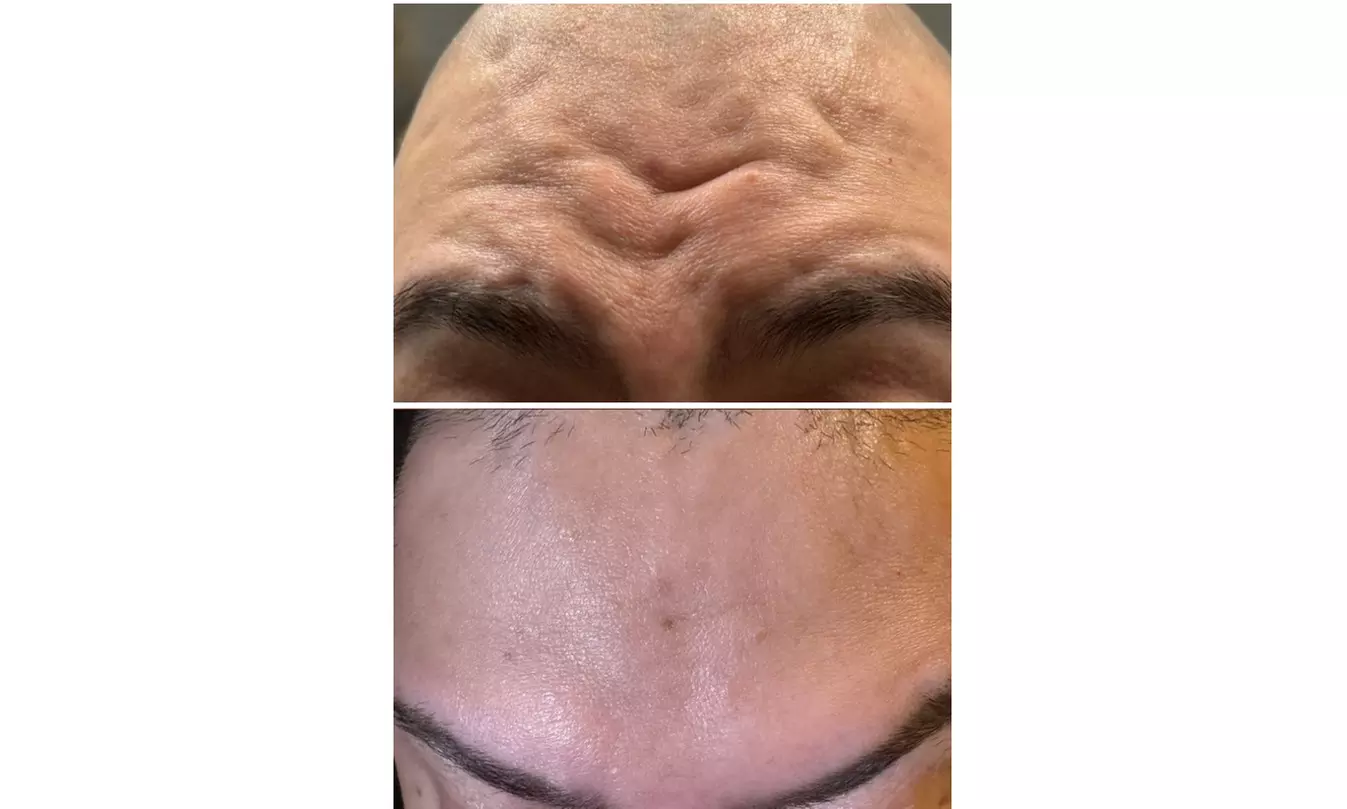 Smooth & Refreshed with 20, 40 or 60 Units of Xeomin at the GLO suite 