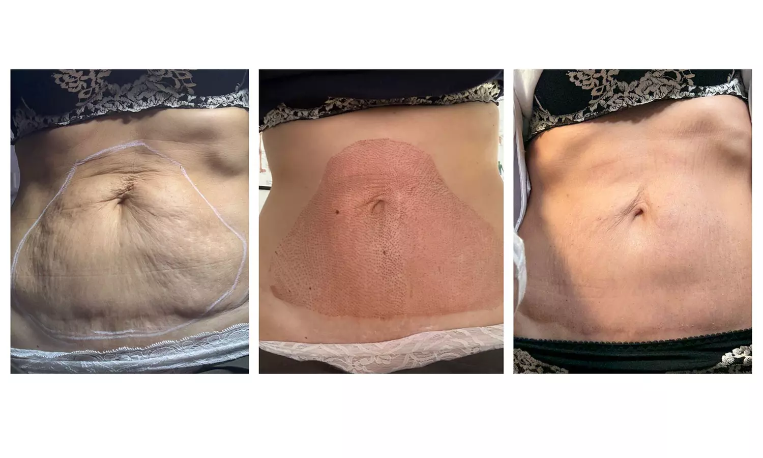 Plasma pen facial no quirúrgico para manchas y zona periocular