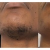 Image 2: 6 Sessions of Aerolase® Neo Elite Laser Hair Removal 