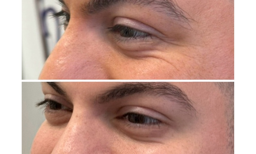 Image 2: First or ToxBooster 20 Units of Botox with Optional VI Peel