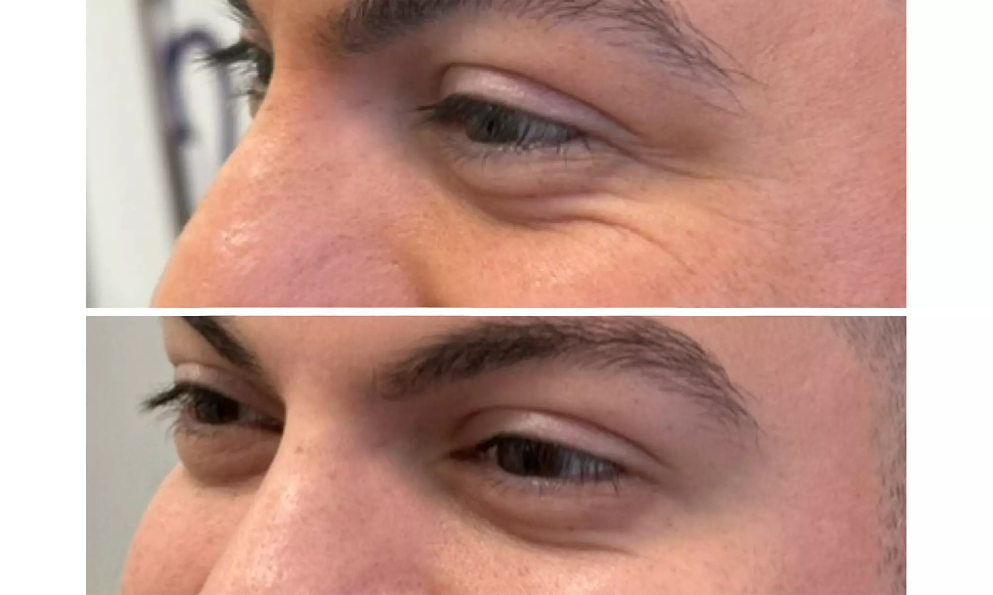 First or ToxBooster 20 Units of Botox with Optional VI Peel