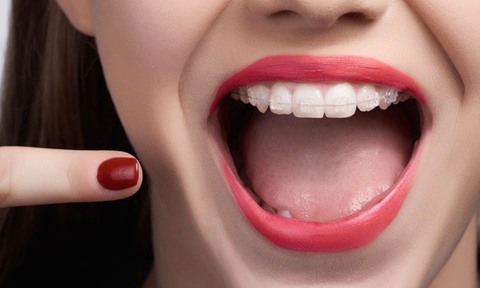 Limpieza dental y férula de descarga blanda o impresa Michigan