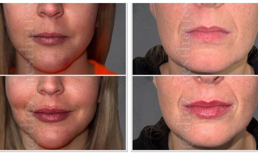 Image 1: Up to 57% Off on Injection - Dermal Filler at Diez Anti-aging Aesthetics