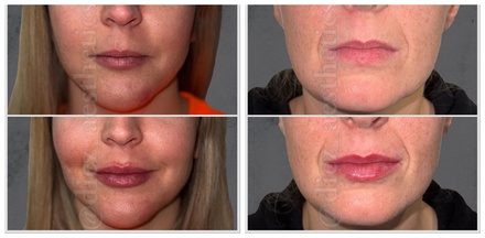 Clinical Dermal Filler with Consultation - 0.5 ml - Diez Anti-Aging Aesthetics