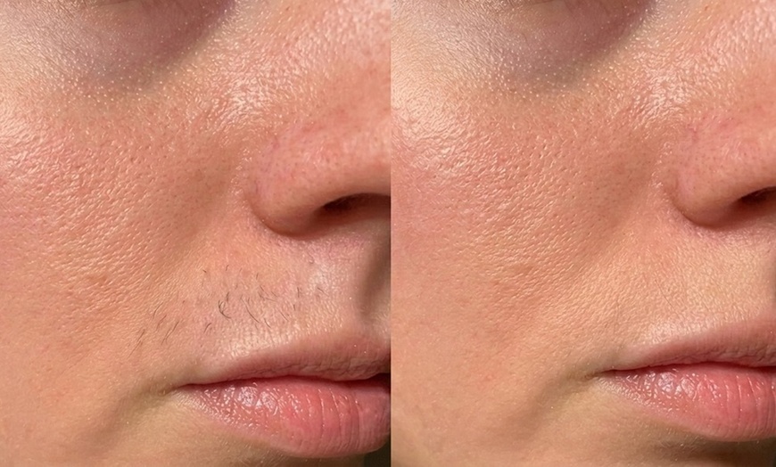 Image 3: 30 or 60-Minute Electrolysis Sessions for Long-Lasting Hair Reduction