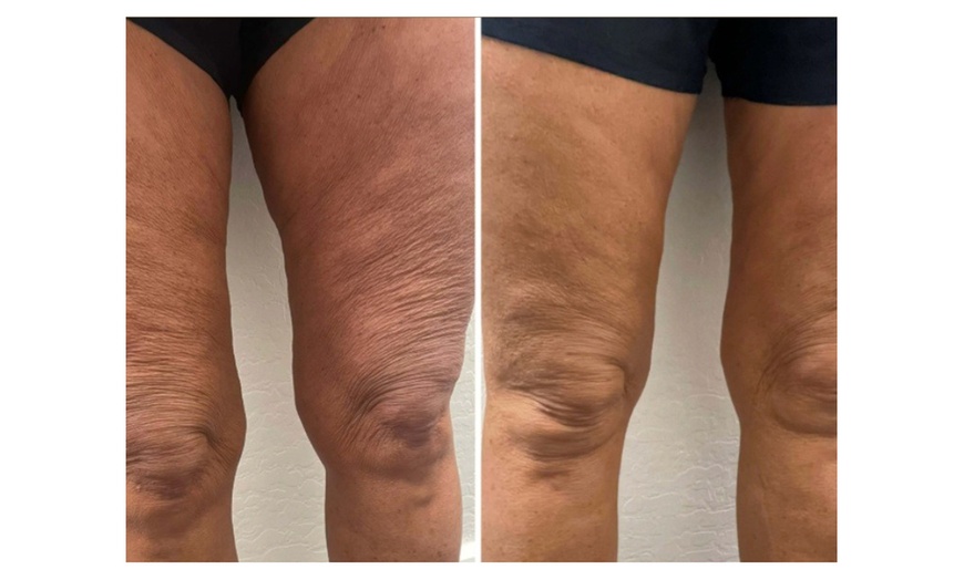 Image 5: One, Three, or Five Laser Lipo Sessions for Waistline
