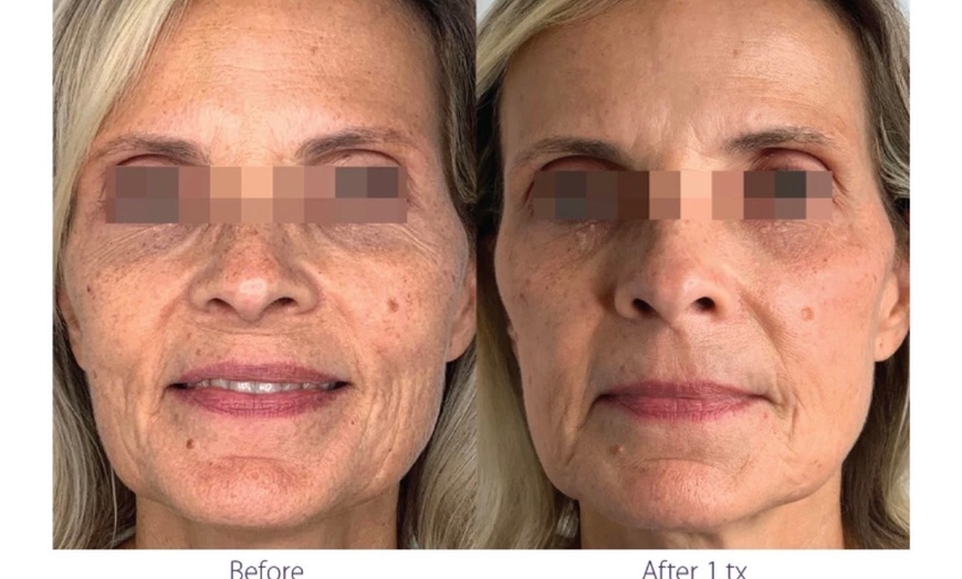 Image 3: ClearLift Laser Session: Face or Face & Neck Rejuvenation