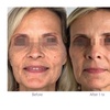 Image 3: ClearLift Laser Session: Face or Face & Neck Rejuvenation