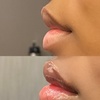 Image 3: Smooth & Radiant: Rejuvenate with Xeomin Injections Today!