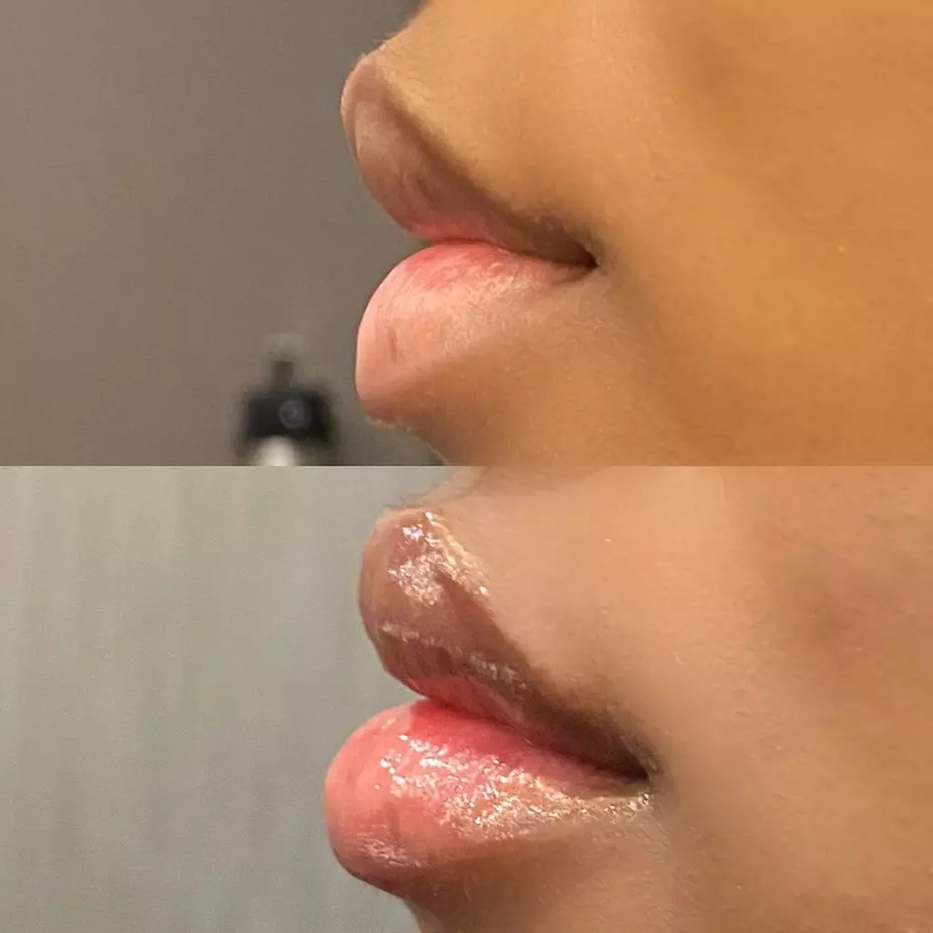 Smooth & Radiant: Rejuvenate with Xeomin Injections Today!