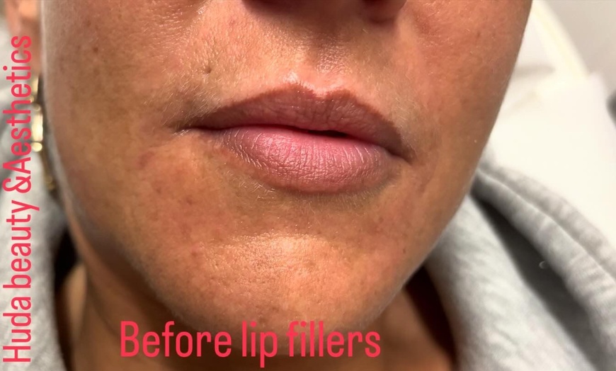 Image 2: Up to 64% Off on Dermal Filler at Huda Beauty & Aesthetics