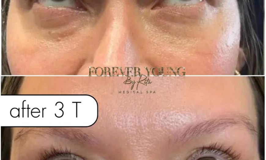 Image 5: One PRF Under Eye Treatment OR One PRF Full Face Rejuvenation