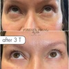 Image 5: One PRF Under Eye Treatment OR One PRF Full Face Rejuvenation