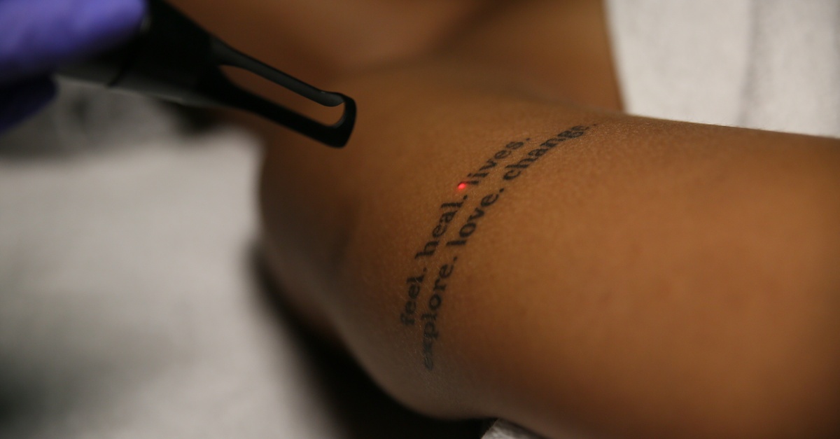 Sesión de eliminación de tatuaje de 5x5 cm con PicoLáser en Tarragona