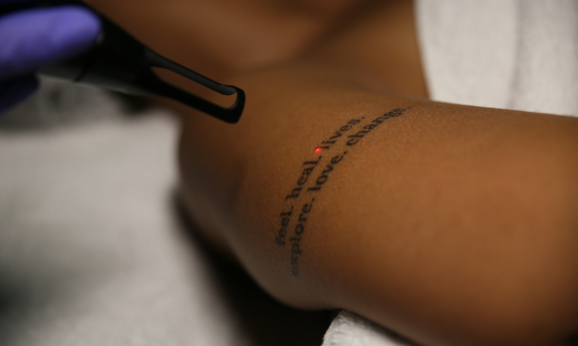 Eliminación de tatuaje 5x5 cm, una o dos sesiones