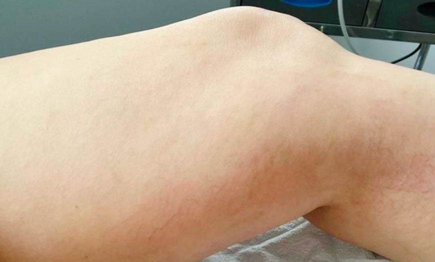 Image 2: Consult, Ultrasound, Vein Removal Injection (10cc) for a 2x2 Area