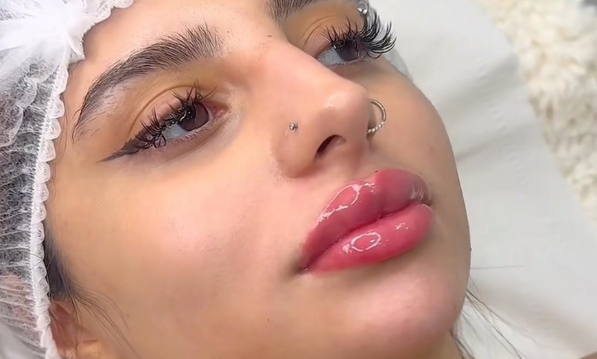 Image 1: Subtle to Full-Face Enhancements with 1ml, 2ml, or 3ml Dermal Filler 