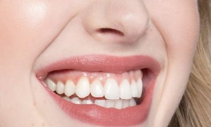 Image 1: Scale and Polish with a Choice of Laser Teeth Whitening at Denticare