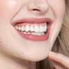 Image 1: Scale and Polish with a Choice of Laser Teeth Whitening at Denticare