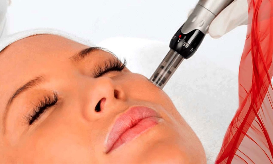 Image 5: Sesiones de rehidratación de labios, Dermapen facial y exosomas