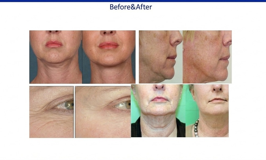 Image 3: Glow with 2 or 4 Thermal Rejuvenation Skin-Tightening Facial Lift