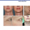 Image 3: Glow with 2 or 4 Thermal Rejuvenation Skin-Tightening Facial Lift