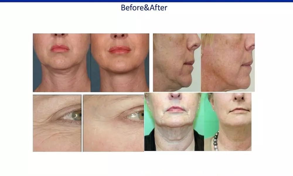 Glow with 2 or 4 Thermal Rejuvenation Skin-Tightening Facial Lift