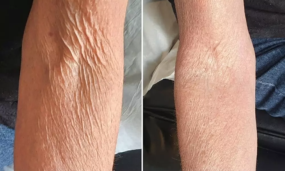 8D Hifu Face and Neck Lift with Two Complimentary Mini RF Treatments