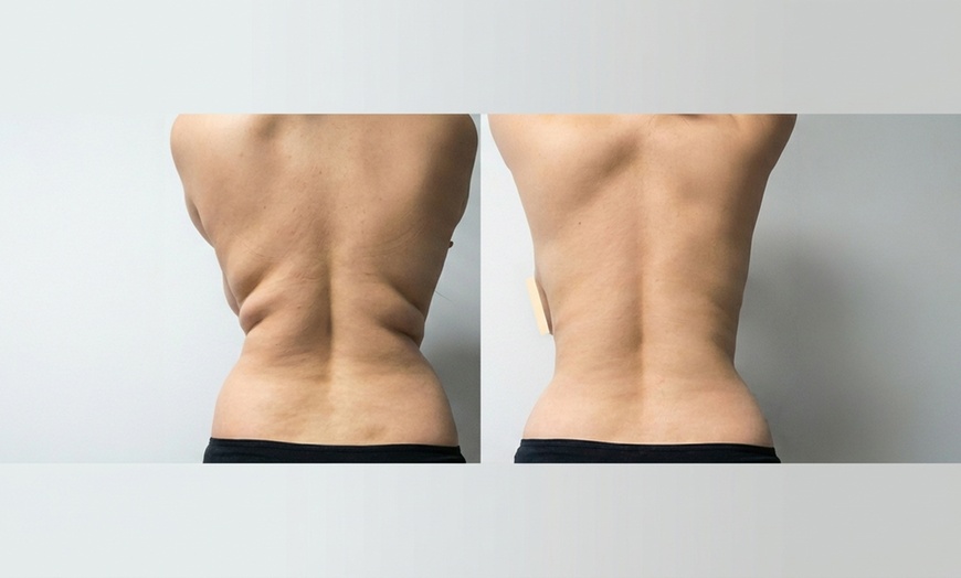 Image 3: One or Three Fat Reduction Treatments with Venus Bliss Max