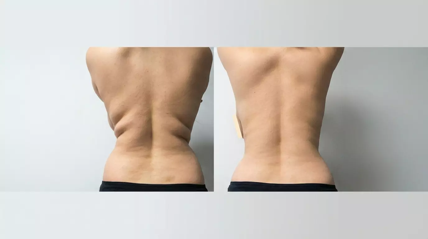 One or Three Fat Reduction Treatments with Venus Bliss Max