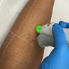 Image 1: Laser Hair Removal Multi-Session Packages