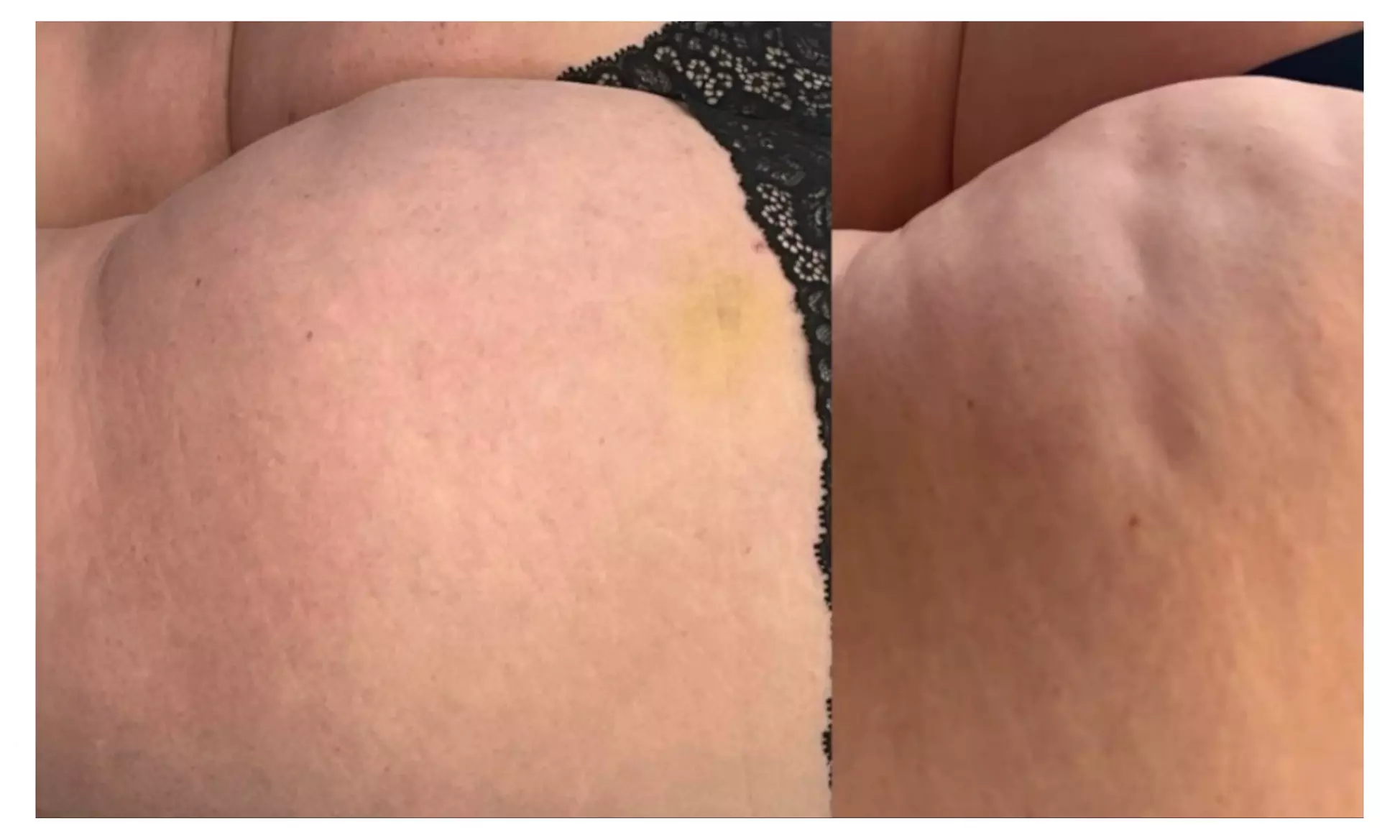 Morpheus 8 Face & Neck Or Abdomen/Butt Skin Tightening Treatment at Skin Dealer (Up to 50% Off) - Second Medium