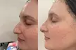 Rediscover Radiance with 20 or 40 Units of Xeomin Treatments at Aphrodite Medical PLLC (Up to 7% Off) - Second Medium