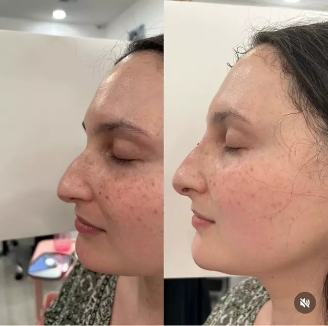 20 or 40 Units of Daxxify! Enhance Youthful Appearance In 1 or 2 Areas