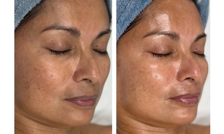 HydraGlow Microdermabrasion Facial - Rise Skin Spa