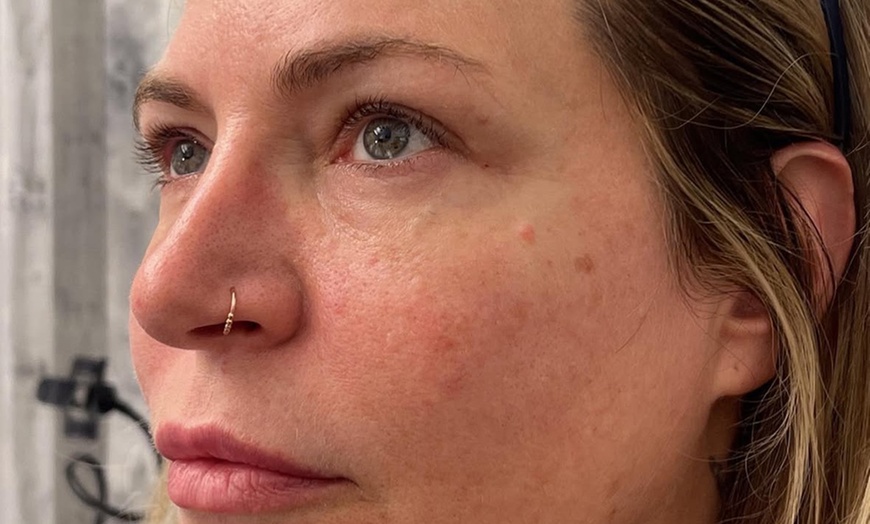 Image 5: Up to 50% Off on Injection - Botox at My Youth Med Spa