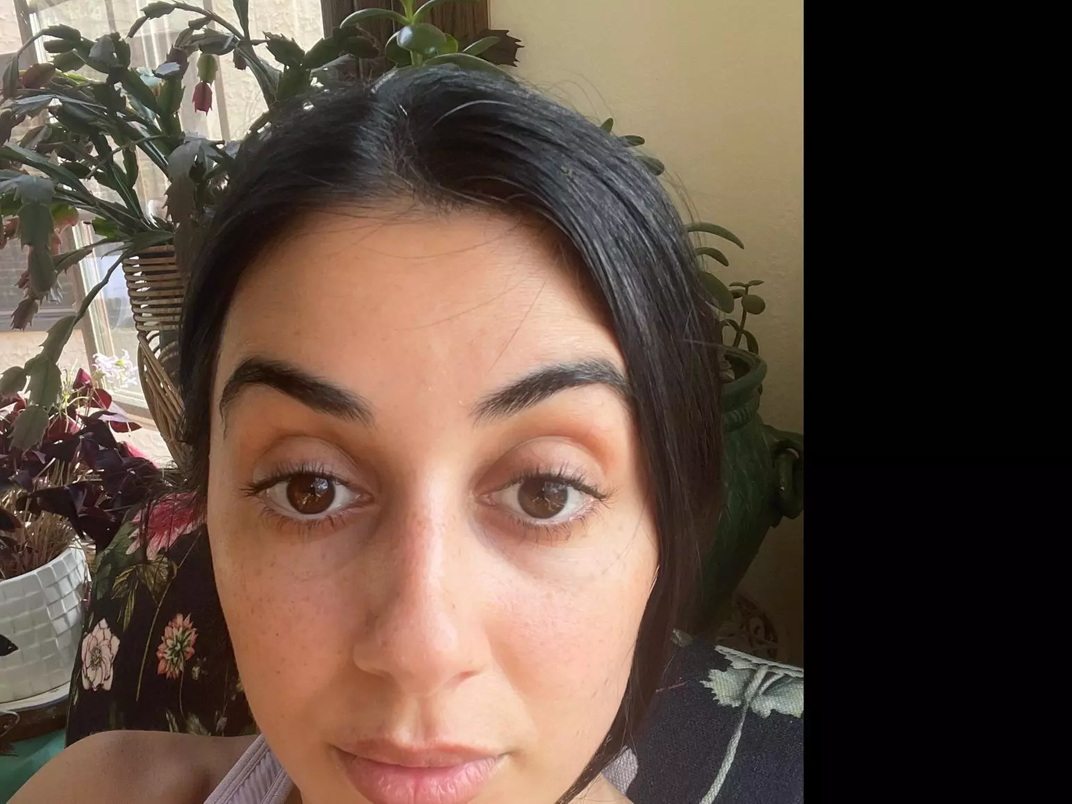 20 or 40 Units of Daxxify! Enhance Youthful Appearance In 1 or 2 Areas