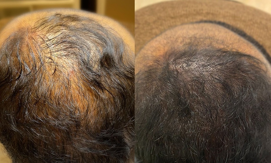 Image 4: Haarpigmentierung, Narbenkorrektur oder Kurzhaarschnitt für 1 Person