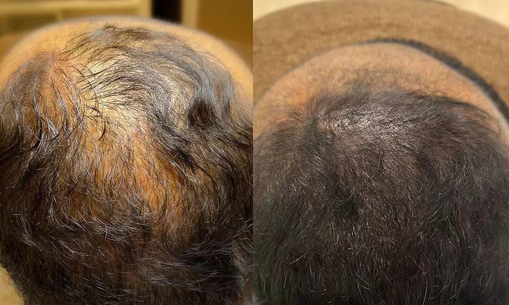 Haarpigmentierung, Narbenkorrektur oder Kurzhaarschnitt für 1 Person