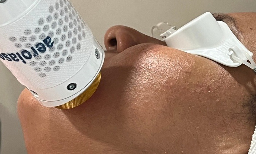 Image 3: One, Three, or Five Laser Skin Resurfacing Treatments