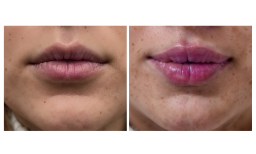 Image 1: Define Your Features with Custom Dermal Filler Packages 1ml - 4ml
