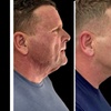 Image 5: Morpheus8 Non-surgical Tightening - Allure Passions Aesthetic Clinic