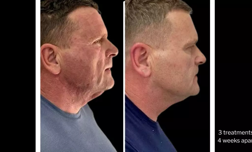 Morpheus8 Non-surgical Tightening - Allure Passions Aesthetic Clinic