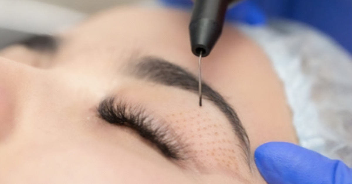 Tratamiento facial Plasma Pen en Sevilla para una zona a elegir
